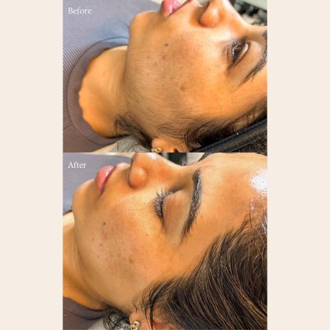 Dermaplaning Facial